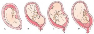 tipi placenta mip